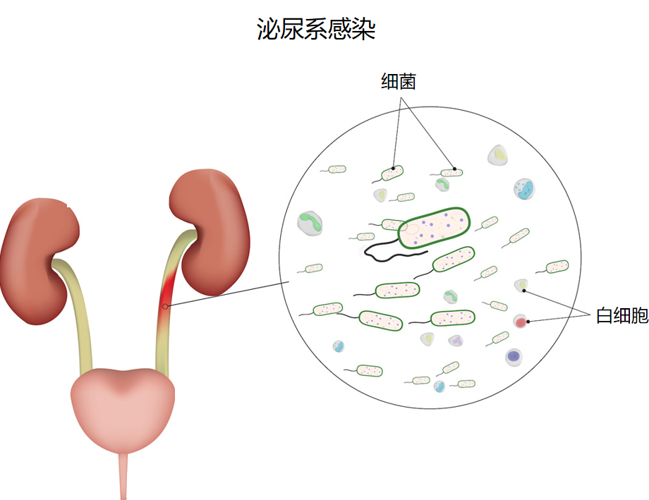 三伏天尿路結(jié)石的“高發(fā)季”，有哪些常見誤區(qū)