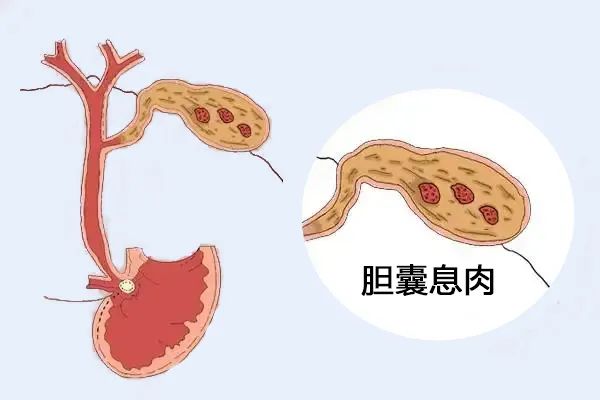 體檢出膽囊息肉，需要擔心嗎？