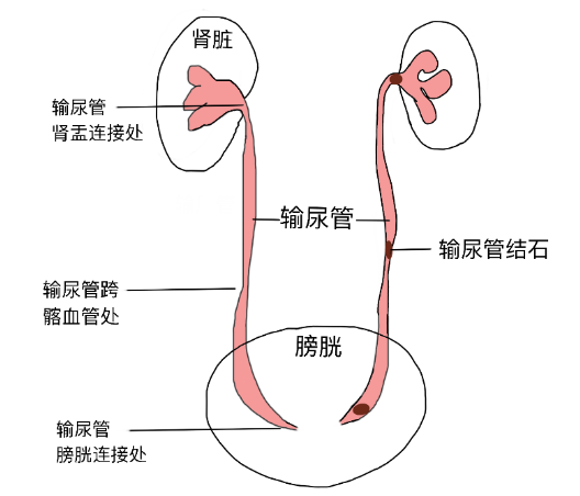 結(jié)石引發(fā)劇烈腎絞痛，該怎么辦？