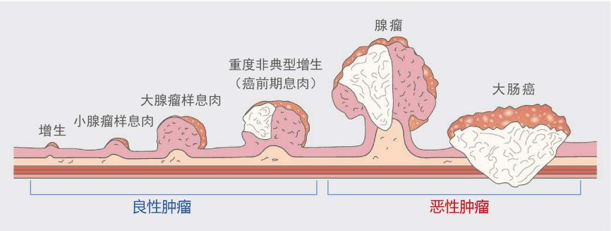 什么樣的腸息肉容易癌變？有一種要特別當心！