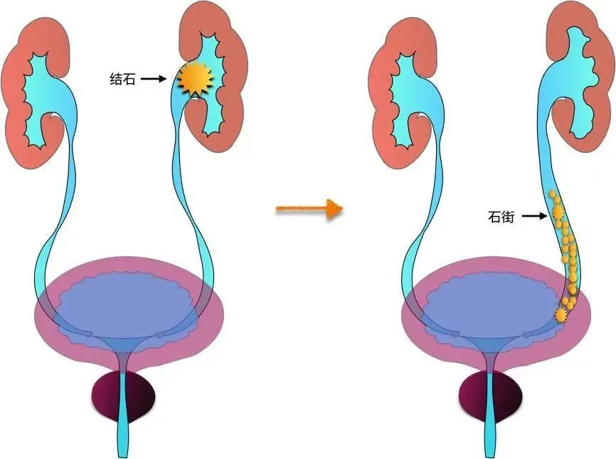 你經(jīng)歷過腎絞痛嗎？該如何緩解治療？